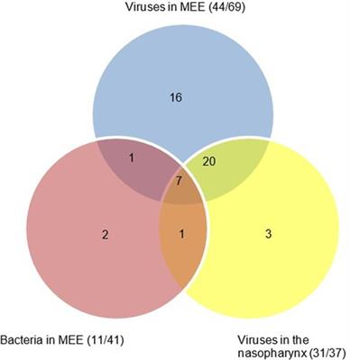 Viral infection in chronic otitis media with effusion in children